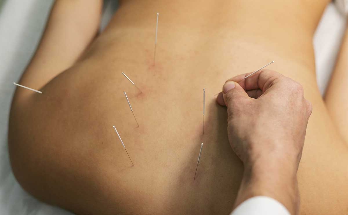 rejuvenecimiento-corporal-con-acupuntura-en-gijon